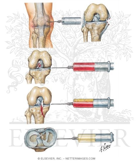 Arthrocentesis of Knee Joint