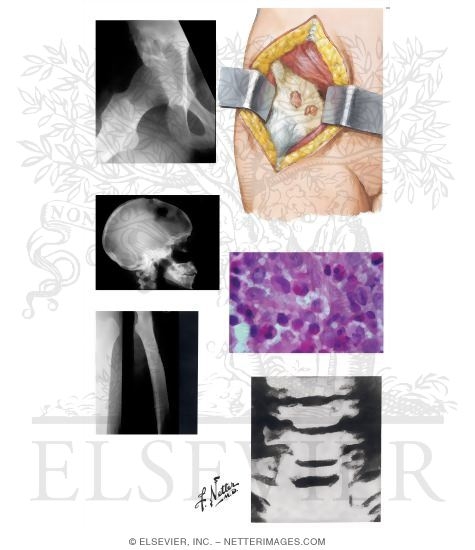 Watermarked preview of unlabeled image: Eosinophilic Granuloma