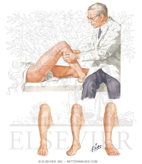 Watermarked preview of unlabeled image: Tests for Anterior and Posterior Drawer and Rotatory Instability of Knee