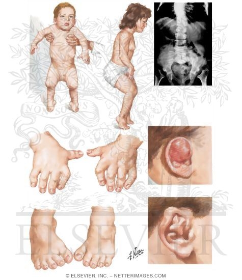Diastrophic Dwarfism