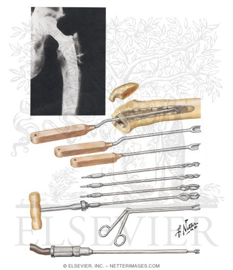 Watermarked preview of unlabeled image: Loosening of Femoral Component