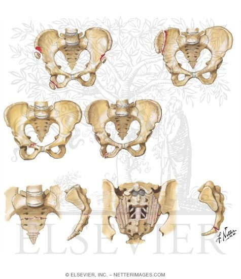 Fracture of Pelvis Without Disruption of Pelvic Ring