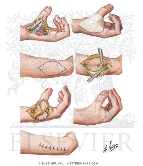 Watermarked preview of unlabeled image: Lateral Arm Flap for Defect of Thumb Web