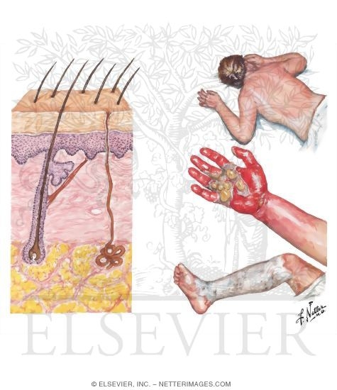 Watermarked preview of unlabeled image: Classification of Burns