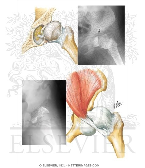 Adaptive Changes in Dislocated Hip Interfering with Reduction