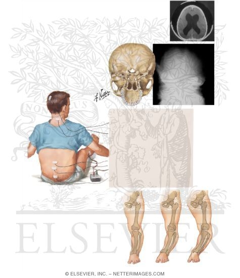 Watermarked preview of unlabeled image: Achondroplasia