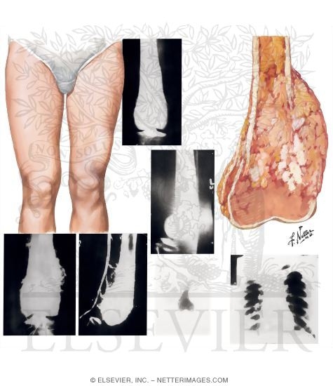 Watermarked preview of unlabeled image: Osteosarcoma