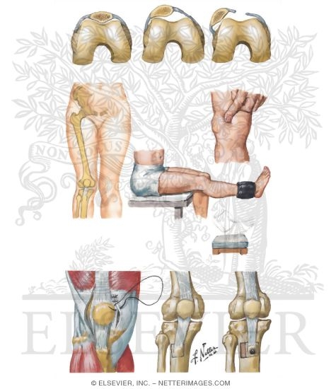 Subluxation and Dislocation of Patella