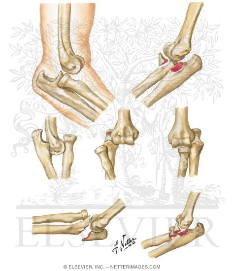 Dislocation of Elbow Joint