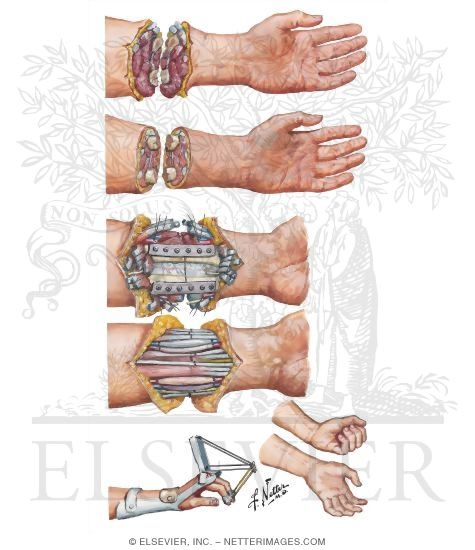 Watermarked preview of unlabeled image: Replantation of Forearm