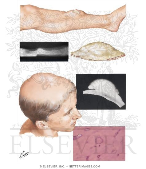 Osteoma