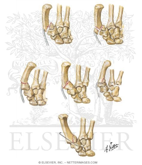 Fracture of Base of Metacarpal of Thumb
