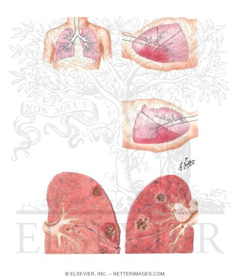 Lung Abscess