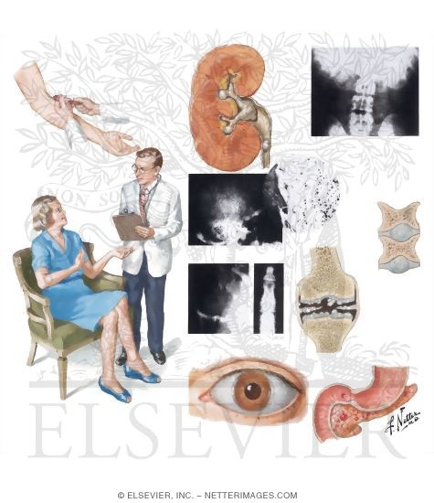 Watermarked preview of unlabeled image: Clinical Manifestations of Primary Hyperparathyroidism