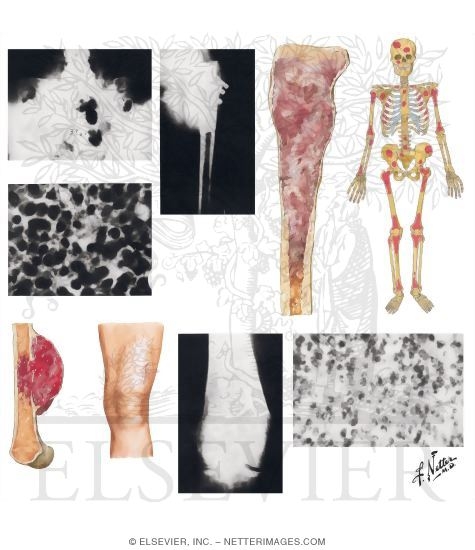 Myeloma, Reticulum-Cell Sarcoma