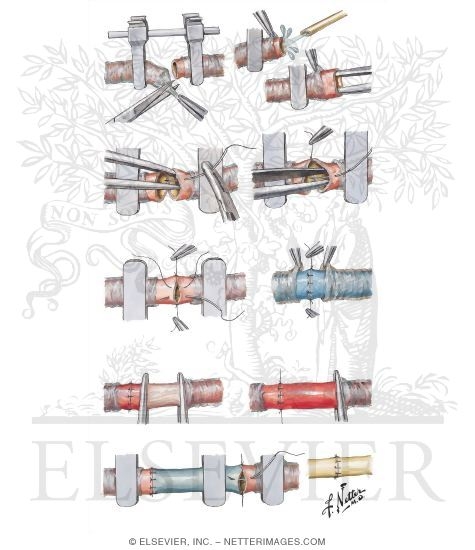 Repair of Blood Vessels and Nerves