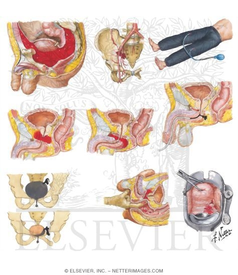 Watermarked preview of unlabeled image: Vascular and Visceral Trauma in Fracture of Pelvis