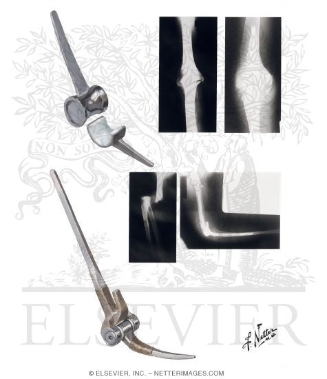 Watermarked preview of unlabeled image: Total Elbow Replacement