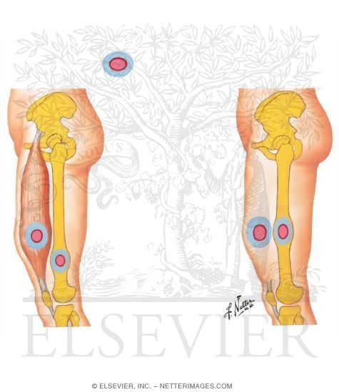 Watermarked preview of unlabeled image: Surgical Margins for Musculoskeletal Tumors