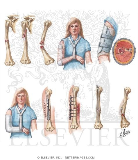 Fracture of Shaft of Humerus