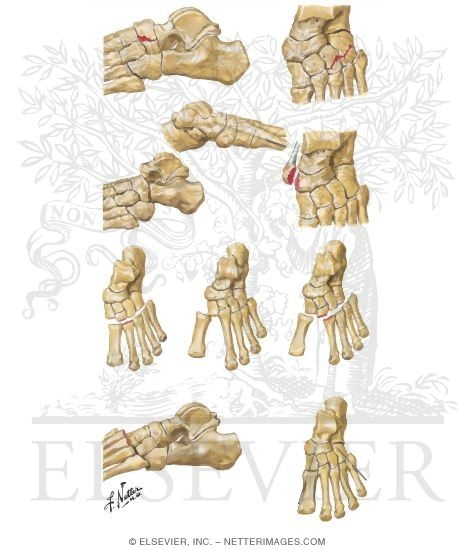 Injury to Midtarsal (Chopart) Joint Complex
Injury to Tarsometatarsal (Lisfranc) Joint Complex