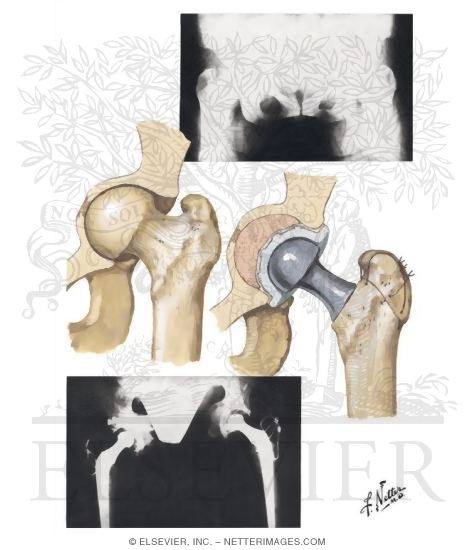 Protrusio Acetabuli