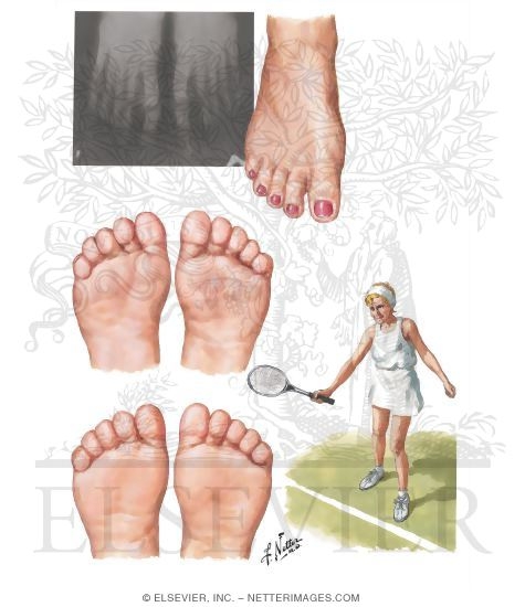Results of Forefoot Reconstruction