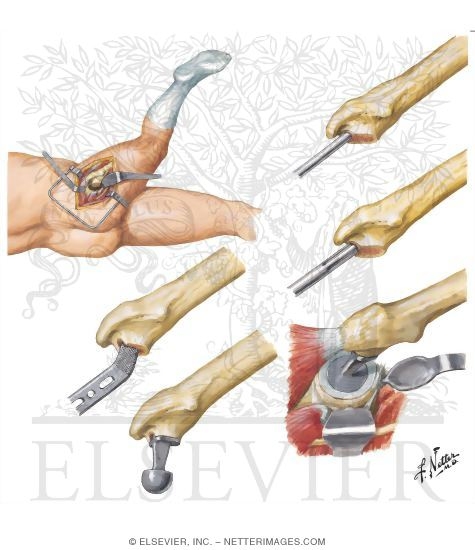 Watermarked preview of unlabeled image: Technique for Total Hip Replacement