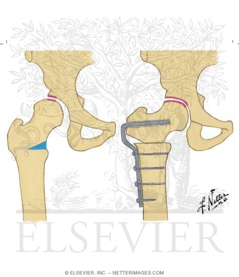 Watermarked preview of unlabeled image: Intertrochanteric Osteotomy