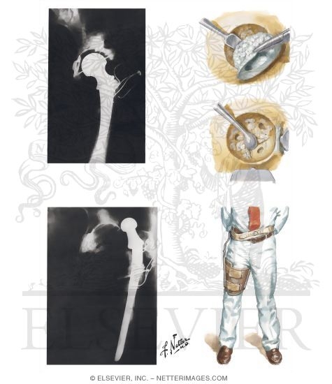 Watermarked preview of unlabeled image: Loosening of Acetabular Component, Dislocation of Total Hip Prosthesis