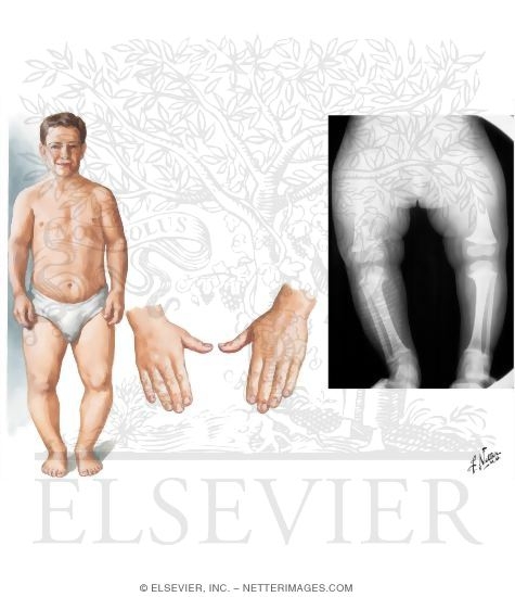 Metaphyseal Chondrodysplasias