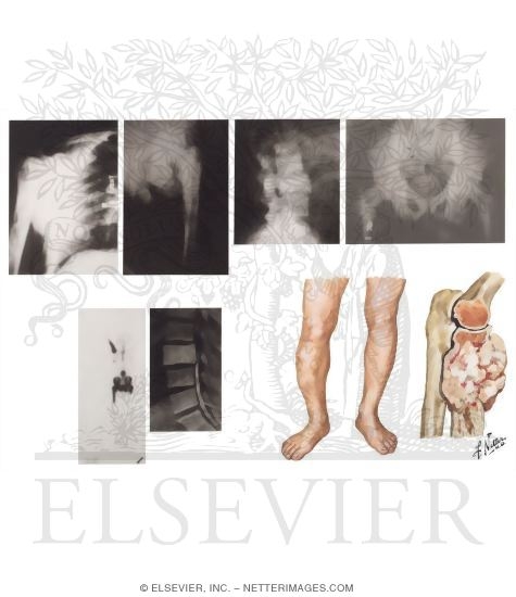 Watermarked preview of unlabeled image: Paget's Disease of Bone