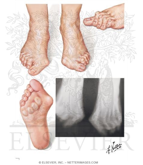 Watermarked preview of unlabeled image: Forefoot Deformities in Rheumatoid Arthritis