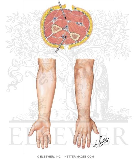 Incisions for Compartment Syndrome of Forearm and Hand
Surgical Approaches
