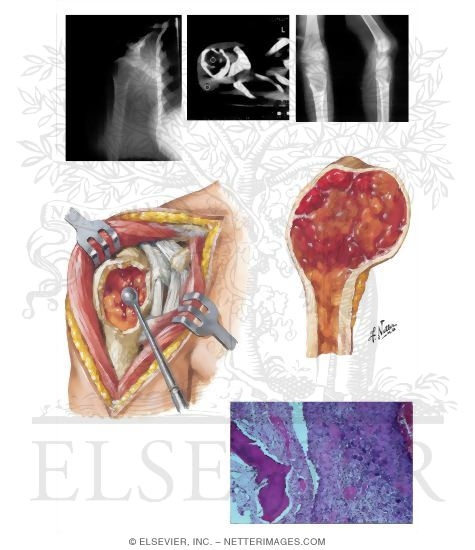Aneurysmal Bone Cyst