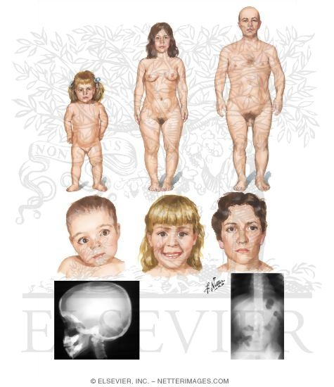 Hypochondroplasia