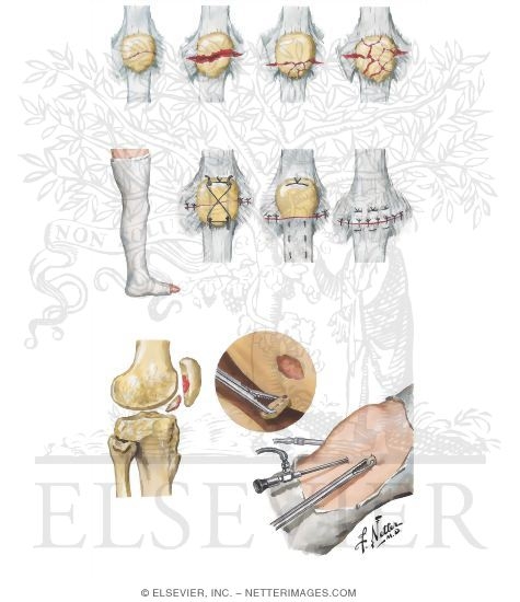 Watermarked preview of unlabeled image: Fracture of Patella
Trauma of the Leg and Knee