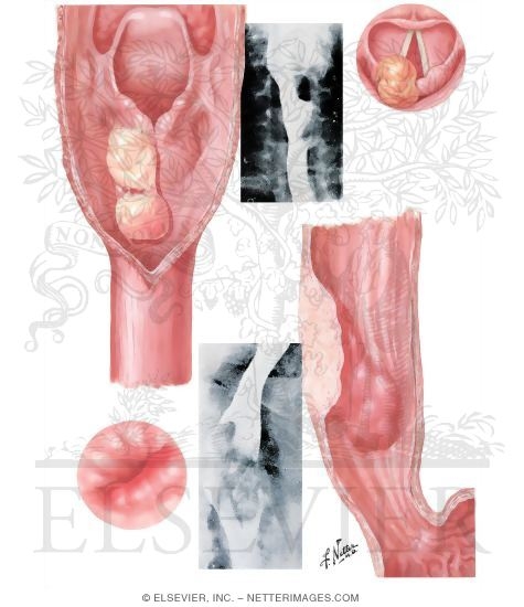 Watermarked preview of unlabeled image: Benign Neoplasms