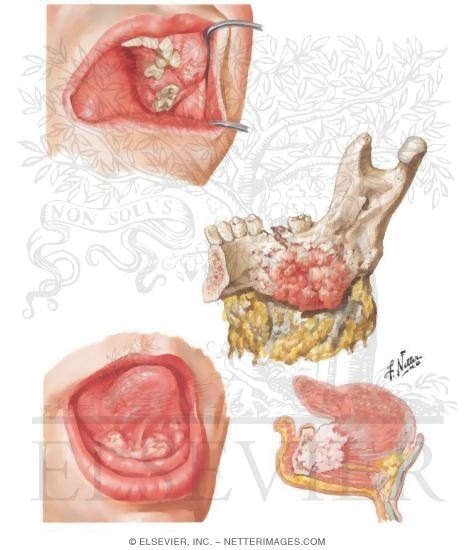 Watermarked preview of unlabeled image: Malignant Tumors III - Jaws
