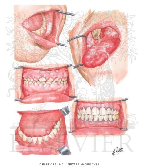 Watermarked preview of unlabeled image: Effects of Chemical Agents on Oral Mucosa