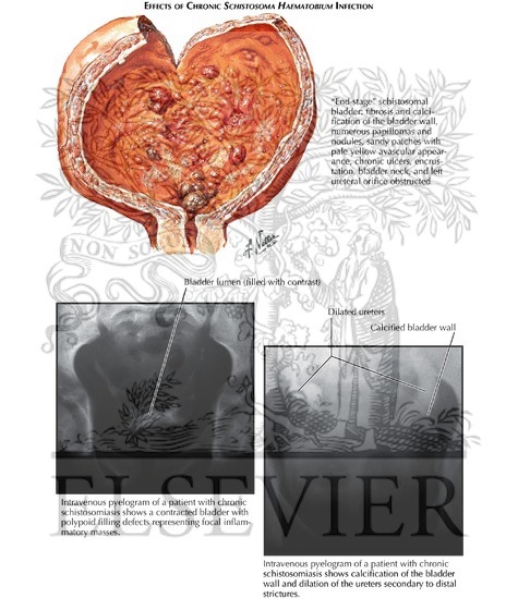 Watermarked preview of unlabeled image: Schistosomiasis: Effects of Chronic Schistosoma Haematobium-Infection