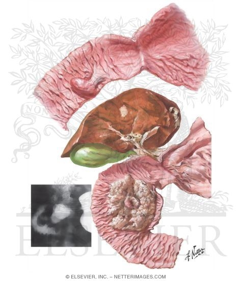Tumors of Duodenum