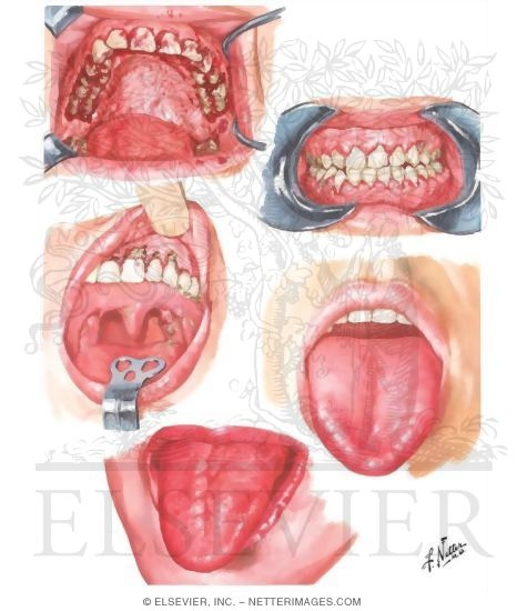 Oral Manifestations in Blood Dyscrasias