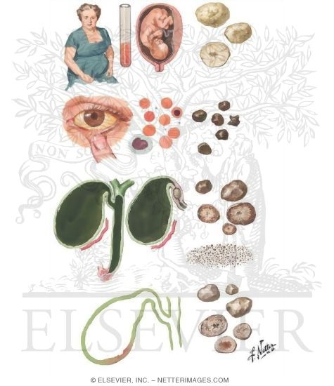 Cholelithiasis I - Stone Formation
Cholecystitis in Pregnancy