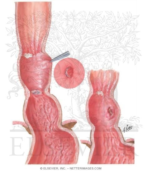 Watermarked preview of unlabeled image: Gastric Peptic Ulcer in Gastric-Lined Esophagus