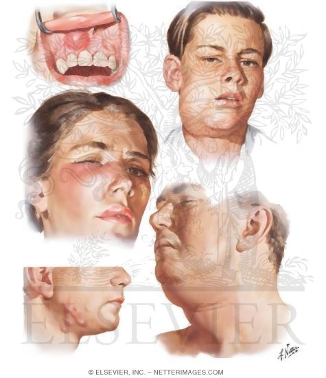 Odontogenic Infections - Their Spread and Abscess Formation
