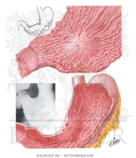 Watermarked preview of unlabeled image: Carcinoma of Stomach