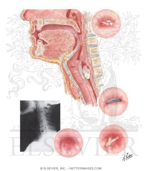 Watermarked preview of unlabeled image: Foreign Bodies In the Esophagus