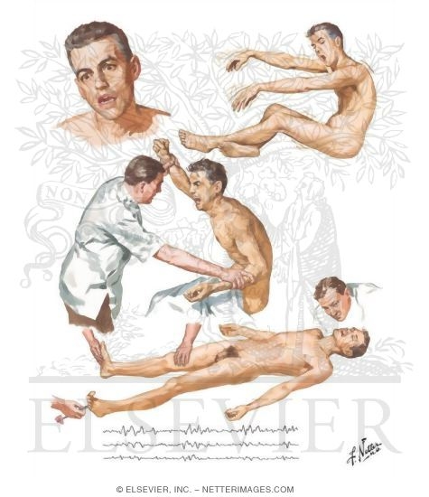 Watermarked preview of unlabeled image: Hepatic Coma