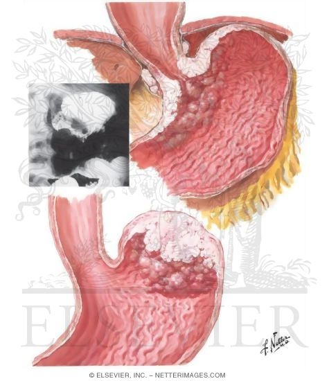 Watermarked preview of unlabeled image: Carcinoma of Stomach